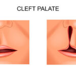 palate