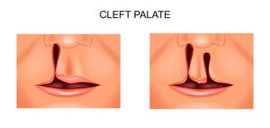palate