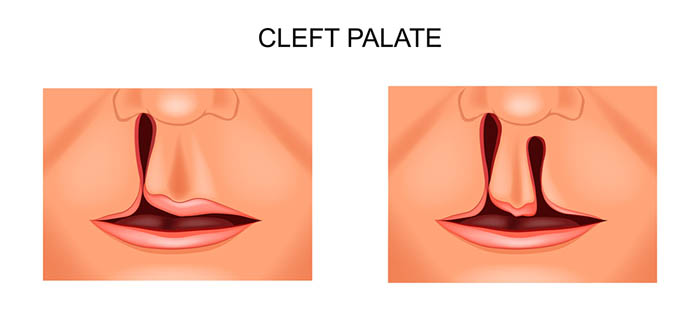 palate